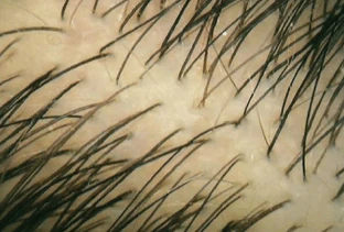 Capelli più folti e densi dopo il trattamento Folicerin