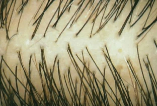 Capelli diradati prima del trattamento con Folicerin anticaduta