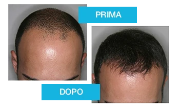 Profolan: risultati visibili nel trattamento capelli