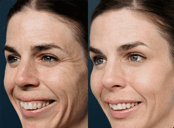 Risultati visibili dopo l'uso di Crema Elesse