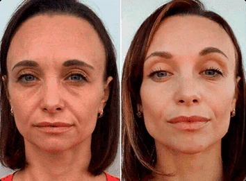 Benefici visibili di Crema Elesse sulla pelle